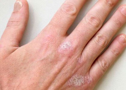 Artrite Psoriática nas Mãos