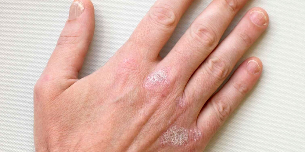 Artrite Psoriática nas Mãos