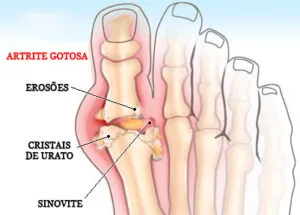 artrite gotosa